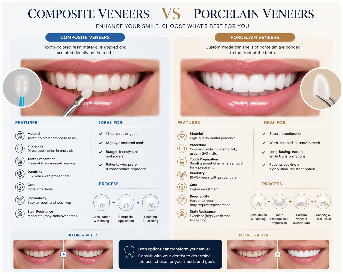 Composite Veneers and Porcelain Veneers