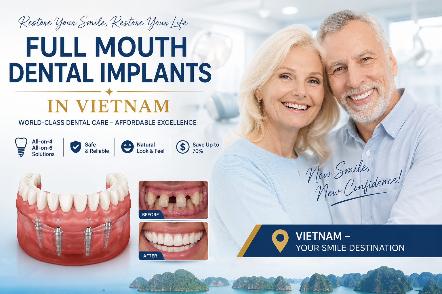 full mouth dental implants in Vietnam