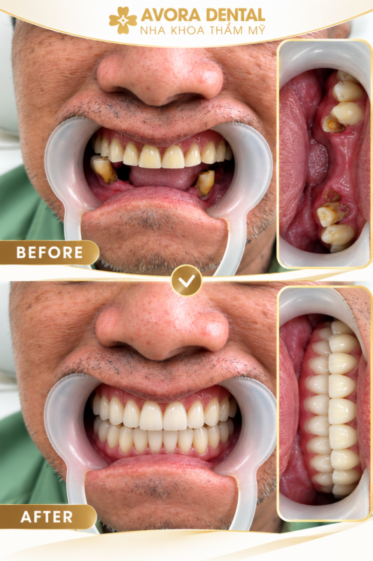 dental implants in Vietnam