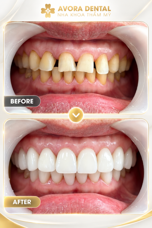 porcelain crowns vs veneers