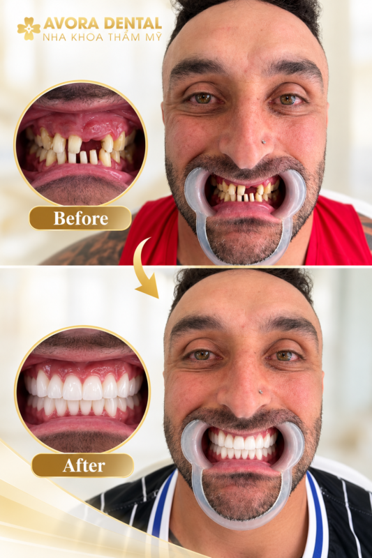 Dental implant recovery