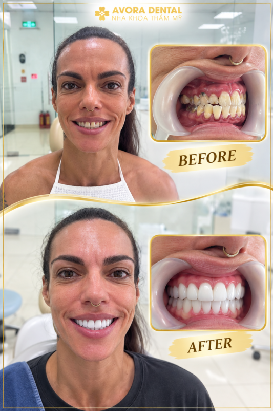 zirconia dental crowns