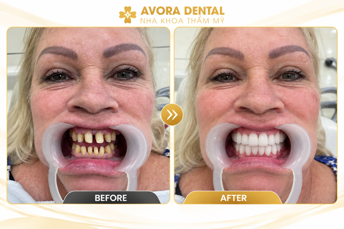 porcelain dental crowns cost in Vietnam